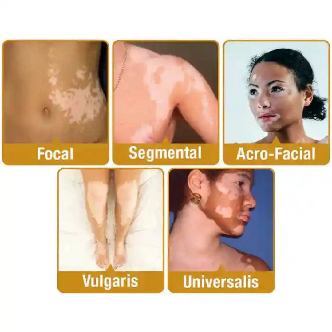 Vitiligo Removal Cream(Buy 1 Get 1 Free)