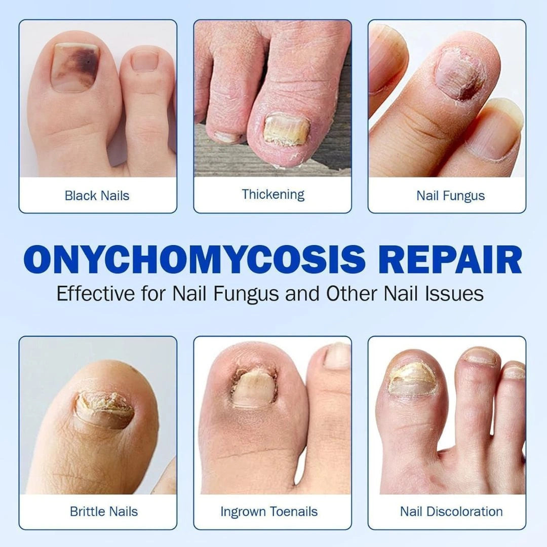 Advanced Fungal Nail Patch Treatment
