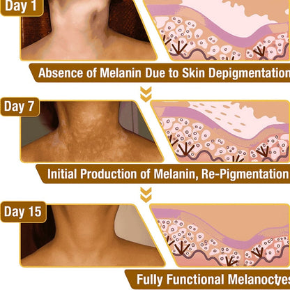 Vitiligo Removal Cream(Buy 1 Get 1 Free)