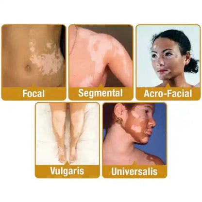 Vitiligo Removal Cream(Buy 1 Get 1 Free)