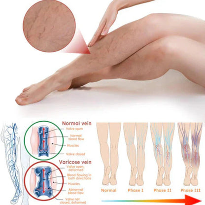 Varicose Veins Treatment Spray(Buy 1 Get 2 Free)