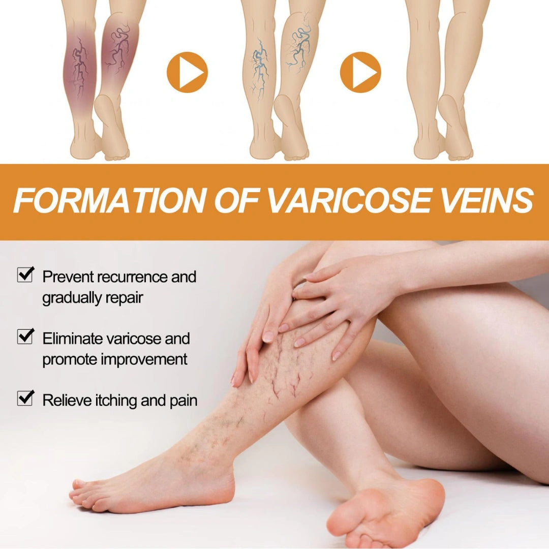 Varicose Veins Treatment Spray(Buy 1 Get 2 Free)