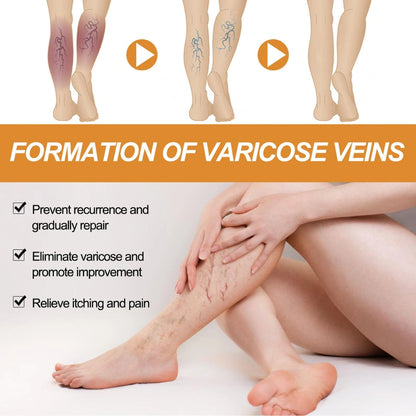 Varicose Veins Treatment Spray(Buy 1 Get 2 Free)