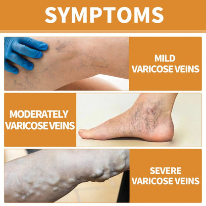 Varicose Veins Treatment Spray(Buy 1 Get 2 Free)