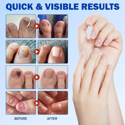 Advanced Fungal Nail Patch Treatment