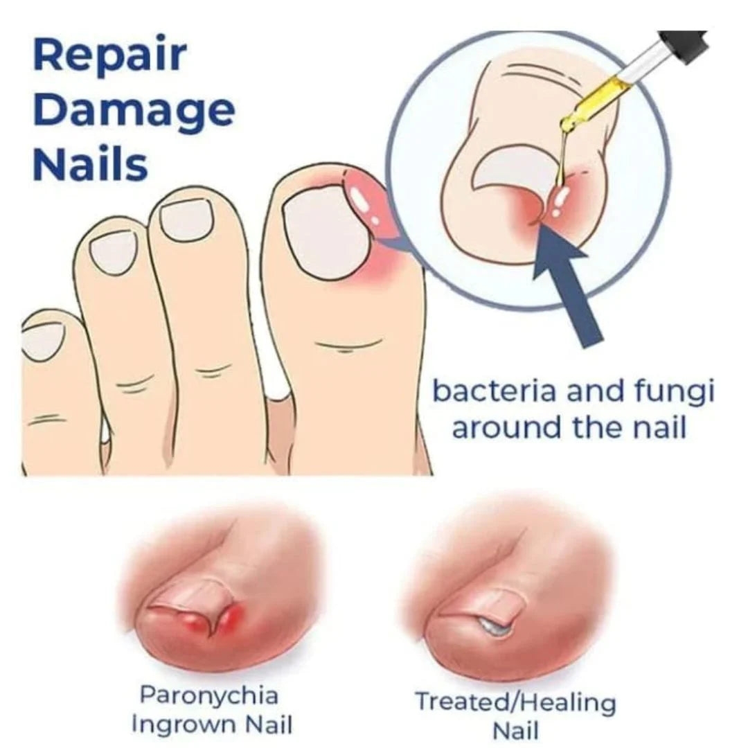 Anti Paronychia Relief Oil