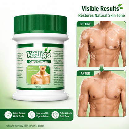 Vitiligo Care Cream