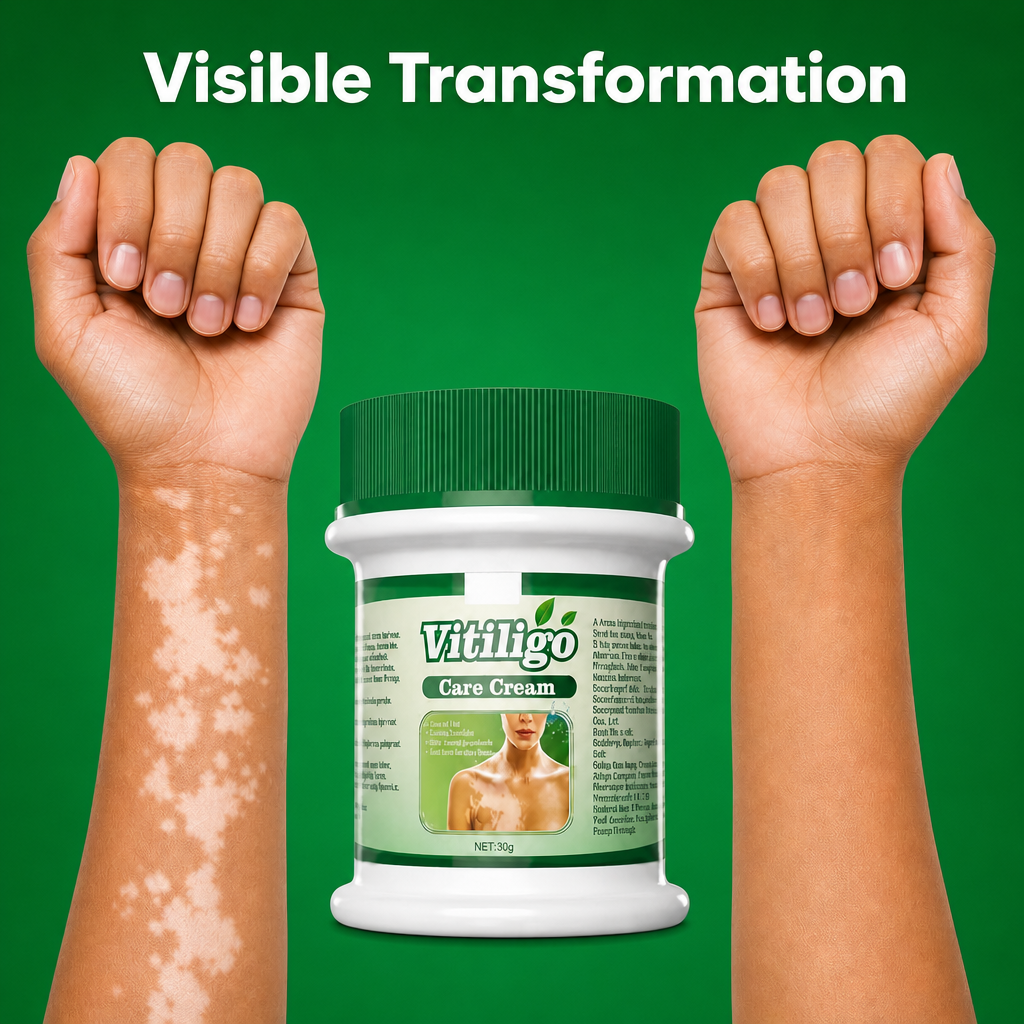 Vitiligo Care Cream