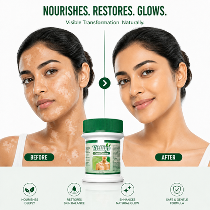 Vitiligo Care Cream